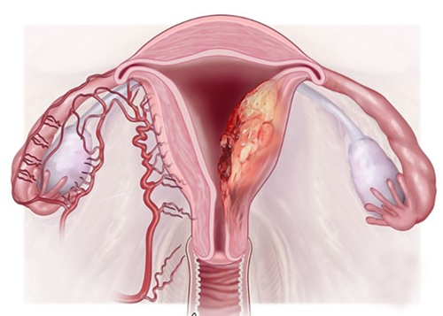 endometrial-cancer.jpg