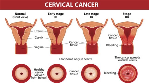 cervical-cancer.jpg