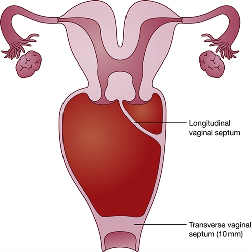 vaginal-septum.jpg